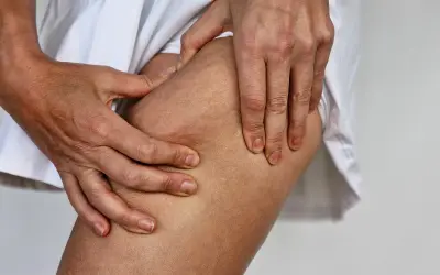 Mani che stringono la coscia, evidenziando la texture della pelle con cellulite e noduli sottopelle.