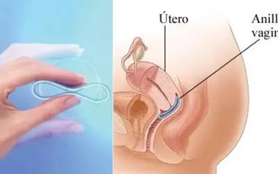 Anillo vaginal anticonceptivo en mano y su ubicación en el útero. No se debe quitar el anillo anticonceptivo durante relaciones.
