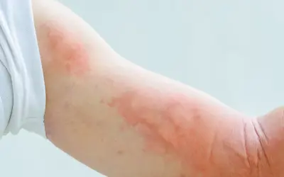 Ramię z widocznymi, rozległymi zmianami rumieniowymi, przypominającymi pokrzywkę lub reakcję alergiczną.