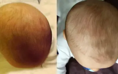 Head Care: Po jakim czasie poduszka skoryguje spłaszczoną główkę?