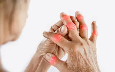 Dita con noduli di Heberden arrossati, un segno di artrosi. L'alimentazione gioca un ruolo nel gestire questa condizione.