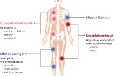 Schemat ciała ludzkiego z zaznaczonymi miejscami występowania mięsaków: chrzęstniakomięsaka, kostniakomięsaka i mięsaka Ewinga.