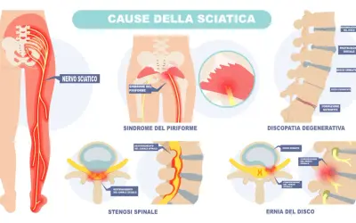 Illustrazione delle cause della sciatica: nervo sciatico, sindrome del piriforme, discopatia degenerativa, stenosi spinale ed ernia del disco.