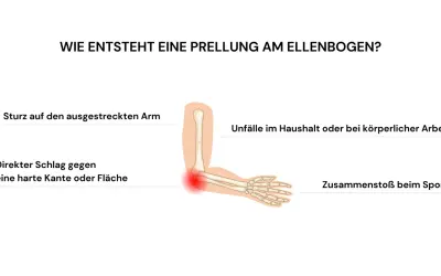 Illustration zeigt, wie **Prellungen nach Sturz** am Ellenbogen entstehen: durch Sturz auf ausgestreckten Arm, Schlag gegen harte Kante, Unfälle oder Sport.