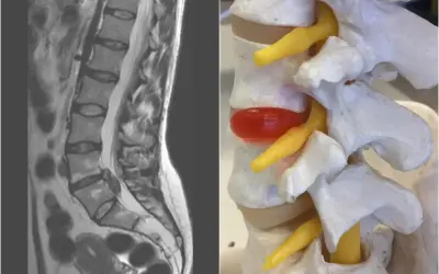 Modelowanie korzeni nerwowych: MRI kręgosłupa lędźwiowego i model anatomiczny z przepukliną dysku uciskającą nerw.