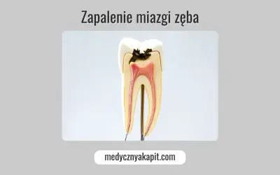 Model zęba ukazujący próchnicę sięgającą miazgi, co prowadzi do zapalenia miazgi.