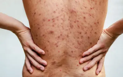 Plecy pokryte licznymi, czerwonymi i ciemnymi zmianami skórnymi, wskazującymi na trądzik piorunujący. Dłonie opierają się na biodrach.