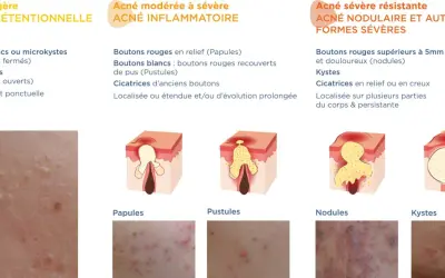 Schéma illustrant les différents types d'acné, des points blancs aux kystes, montrant l'évolution d'un bouton de puberté.