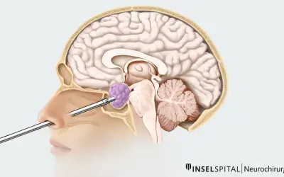 Chirurgischer Eingriff durch die Nase zur Entfernung eines Hypophysentumors.