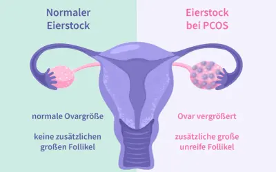 Porównanie jajnika: normalny vs. przy PCOS. Przy PCOS jajnik jest powiększony, z licznymi niedojrzałymi pęcherzykami.