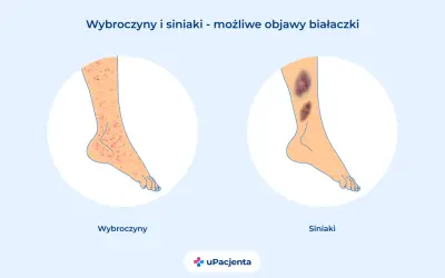 Wybroczyny i siniaki na nogach mogą być objawami białaczki szpikowej. Ilustracja pokazuje zmiany skórne.