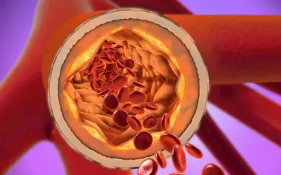 Przekrój tętnicy z widocznymi złogami cholesterolu i czerwonymi krwinkami.