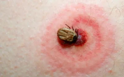 Cómo se llama la enfermedad de las garrapatas y sus riesgos ocultos