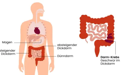 Illustration zeigt den menschlichen Verdauungstrakt mit einem hervorgehobenen Bereich, der Darmkrebs und Geschwüre im Dickdarm darstellt. Frühzeitige Erkennung von Darmkrebs Symptomen ist wichtig.
