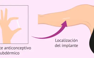 Mano sostiene implante anticonceptivo subdérmico. Flecha indica localización del implante en el brazo.