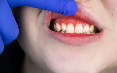 Zapalenie dziąseł, zaczerwienienie i krwawienie to potencjalne objawy raka dziąsła. Wczesne rozpoznanie jest kluczowe.