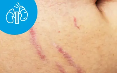 Rozstępy na skórze, symbol nerek w okręgu. Objawy zespołu cushinga mogą obejmować zmiany skórne.