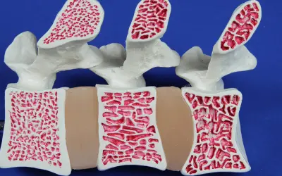 Model kręgosłupa z widoczną strukturą kości. Po lewej kość zdrowa, po prawej widoczne ubytki świadczące o osteoporozie.