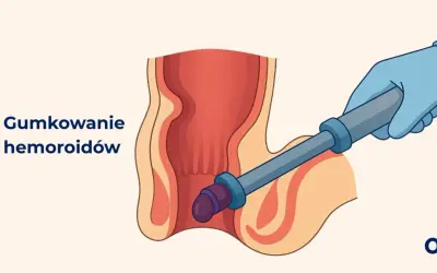 Ilustracja przedstawia zabieg gumkowania hemoroidów. Ręka w niebieskiej rękawiczce używa narzędzia do założenia gumki na hemoroid.