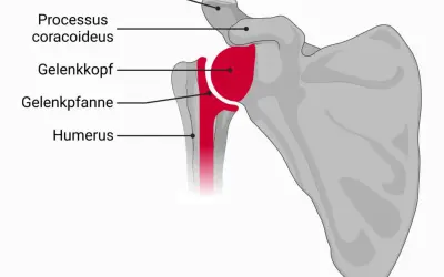 Anatomische Darstellung des Schultergelenks mit Humerus, Gelenkkopf, Gelenkpfanne, Acromion und Processus coracoideus. Eine inverse Schulterprothese ersetzt diese Strukturen.