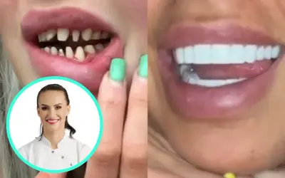 Przed i po: nieudane tureckie zęby, powikłania po zabiegu, a obok uśmiechnięta dentystka.