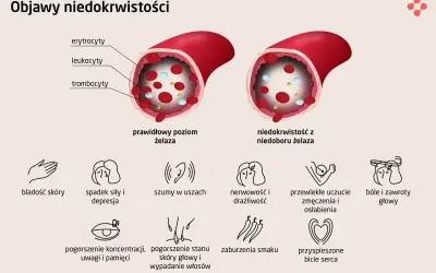 Porównanie prawidłowego poziomu żelaza z niedoborem. Niedobór żelaza prowadzi do anemii, objawiającej się m.in. bladością skóry, zmęczeniem i bólami głowy.