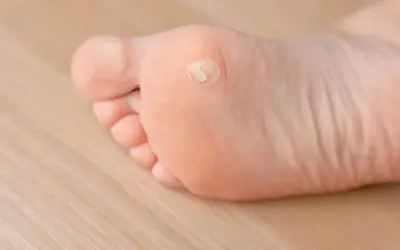 Stopa z odciskiem, który wygląda jak mały, biały plaster z płynem.