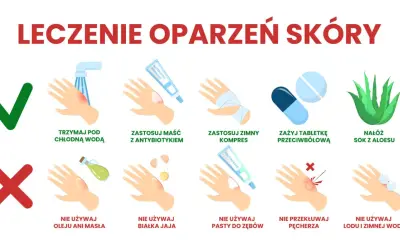 Instrukcja leczenia oparzeń skóry: chłodna woda, maść z antybiotykiem, zimny kompres, leki przeciwbólowe, aloes. Unikaj masła, jajka, pasty do zębów, lodu.