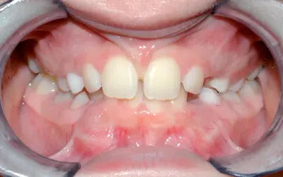 Bocca aperta con denti da latte e il frenulo labiale superiore visibile tra gli incisivi centrali.