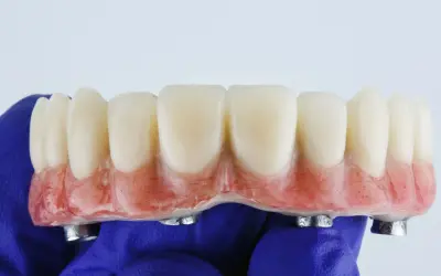 Proteza zębowa na implantach, wykonana w ramach NFZ. Sztuczne zęby z różową podstawą, trzymane w niebieskiej rękawiczce.