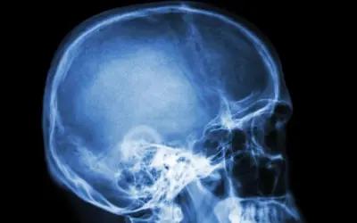 Rentgen czaszki z profilu. Widoczne struktury kostne głowy, w tym jama czaszki, kości twarzy i szczęka. Może to być pomocne w diagnostyce schorzeń wpływających na nerw błędny.