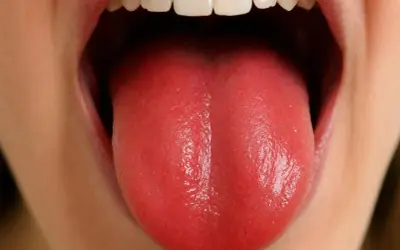 Lingua rossa e liscia, possibile sintomo di carenza vitamina b12.