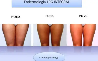 Endermologia: dla kogo? Kiedy warto, a kiedy unikać zabiegu?