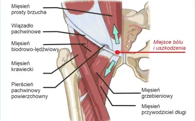 Anatomia pachwiny z zaznaczonym miejscem bólu i uszkodzenia. Ilustracja pokazuje mięśnie brzucha, biodrowo-lędźwiowy, krawiecki oraz pierścień pachwinowy.