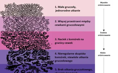 Skala Gleasona ilustruje wyniki biopsji prostaty, pokazując stopnie zróżnicowania komórek od 1 do 5.