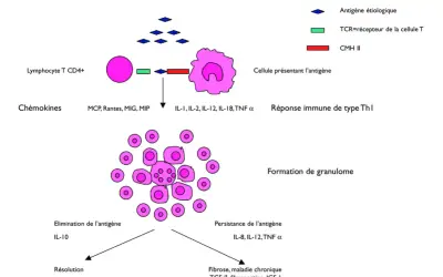 Schéma illustrant la formation de granulomes, un symptôme de la sarcoïdose, impliquant des lymphocytes T et des cellules présentant l'antigène.