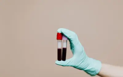 Rękawiczka trzyma probówki z ciemną cieczą, sugerującą krew w moczu po cewnikowaniu.