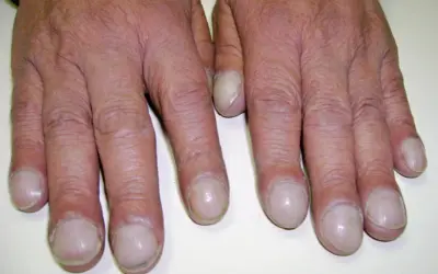 Dita gonfie e unghie arrotondate, segni che possono indicare fibrosi cistica alle mani.