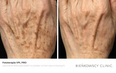 Dłoń przed i po fototerapii. Zmniejszona widoczność przebarwień spowodowanych nadmiarem melaniny.