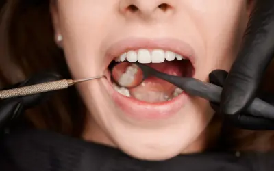 Usta kobiety otwarte, dentysta w czarnej rękawiczce bada ząb mądrości lusterkiem i narzędziem.