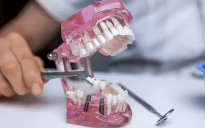 Model szczęki z implantami, gdzie pęsetą umieszczany jest nowy ząb. Pokazane jest wstawienie zęba.