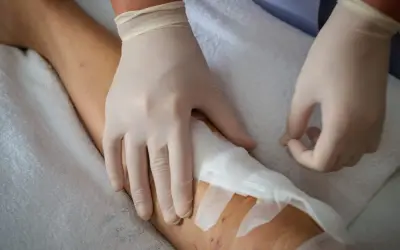 Opatrunek na nodze, pokazujący etapy gojenia rany pooperacyjnej. Ręce w rękawiczkach medycznych zakładają opatrunek.