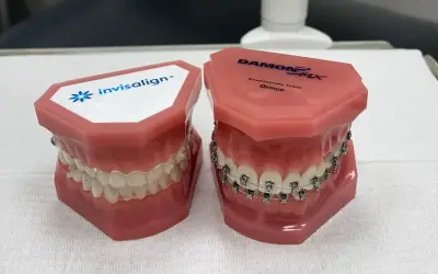 Modele szczęk prezentujące tradycyjny aparat ortodontyczny i dyskretny aparat invisalign.