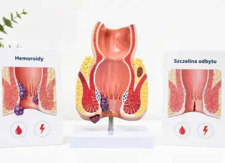 Model anatomiczny odbytu z zaznaczonymi hemoroidami. Choć obrazek dotyczy dorosłych, problem hemoroidów u dzieci również istnieje.