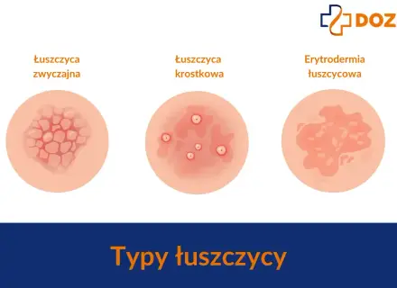 Ilustracje pokazują różne typy łuszczycy: zwyczajną, krostkową i erytrodermię łuszczycową. Ważne, by znać objawy łuszczycy u dzieci.