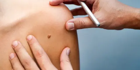 Examen d'un grain de beauté sur l'épaule, un médecin utilise un stylo pour le marquer.