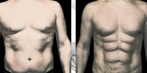 Addome scolpito dopo l'intervento: protesi addominali uomo per un fisico definito.