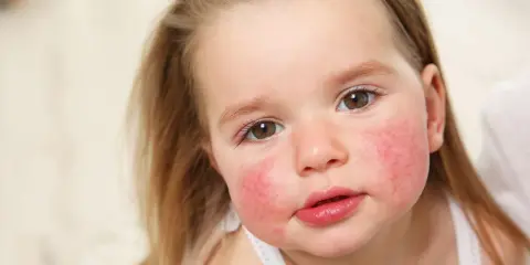 Alergia pokarmowa u dzieci: objawy skórne? Co robić krok po kroku