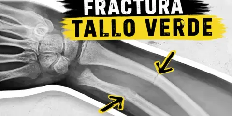 Radiografía de una fractura en tallo verde en el antebrazo, indicada por flechas amarillas.