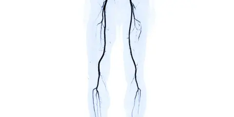 Angiografia delle gambe che mostra l'arteria femorale ostruita, un sintomo di problemi circolatori.